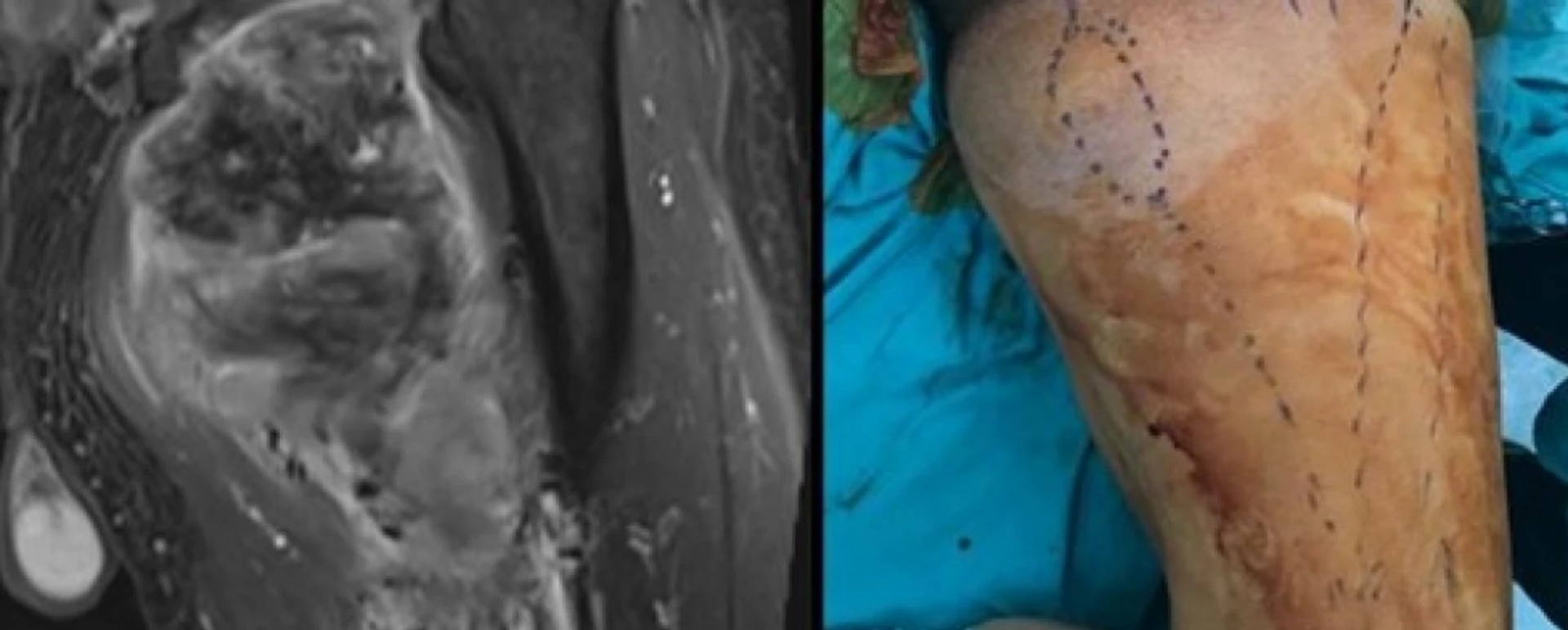 YUMUŞAK DOKU TÜMÖRÜ